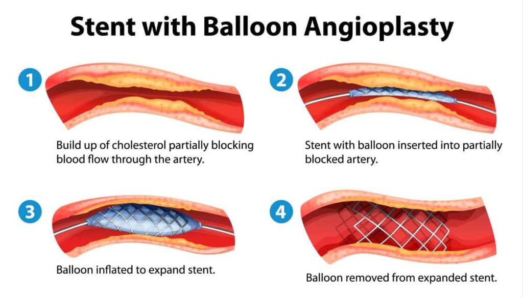 Image that shows how a stent is inserted into artery with a balloon angioplasty.